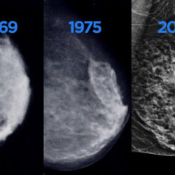 4 Essential Benefits of Getting a Mammogram