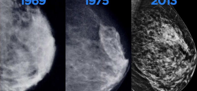 4 Essential Benefits of Getting a Mammogram