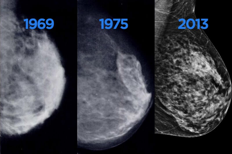 Images from Mammogram from 1969, 1975, 2013