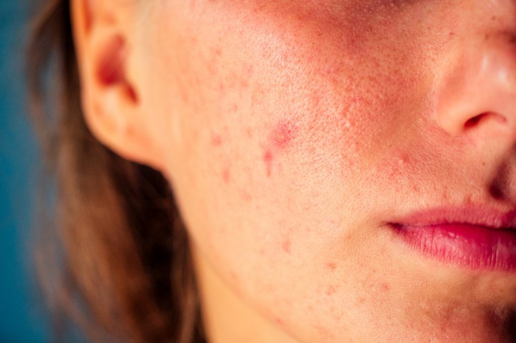 cystic acne