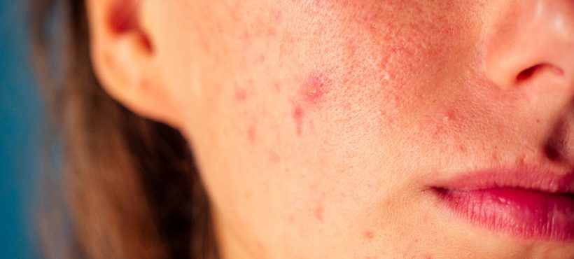 Find Out Why You’re Breaking Out! 7 Causes of Cystic Acne in Adults