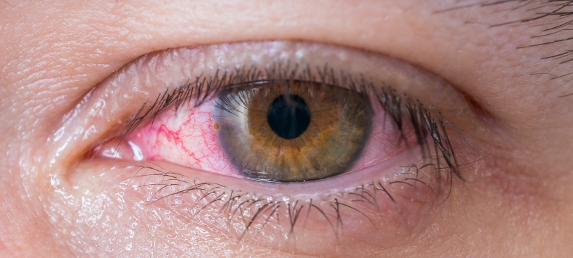 How to Spot the Most Common Eye Infections