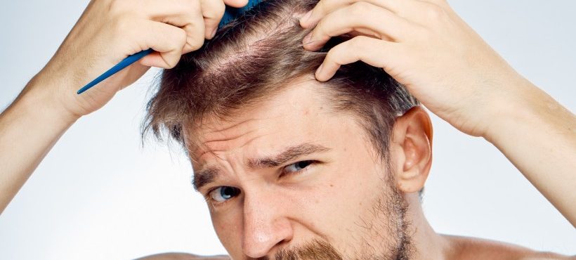 Androgenetic Alopecia: An Encompassing Guide on Male Pattern Baldness