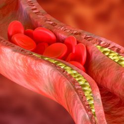 Blood Clots: Risks, Symptoms, Treatments, Prevention