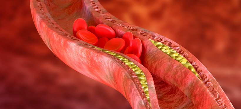 Blood Clots: Risks, Symptoms, Treatments, Prevention