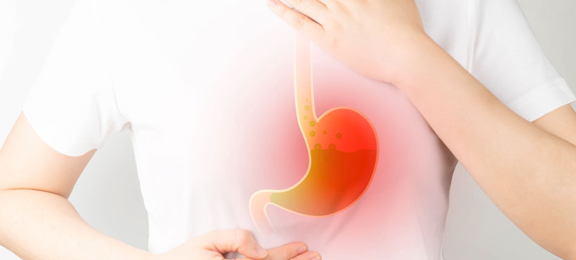 GERD (Acid Reflux): Causes, Symptoms, Diagnose, Treatment